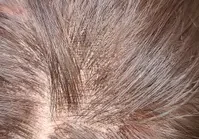 Close-up view of a person's scalp with thinning hair and visible skin patches.