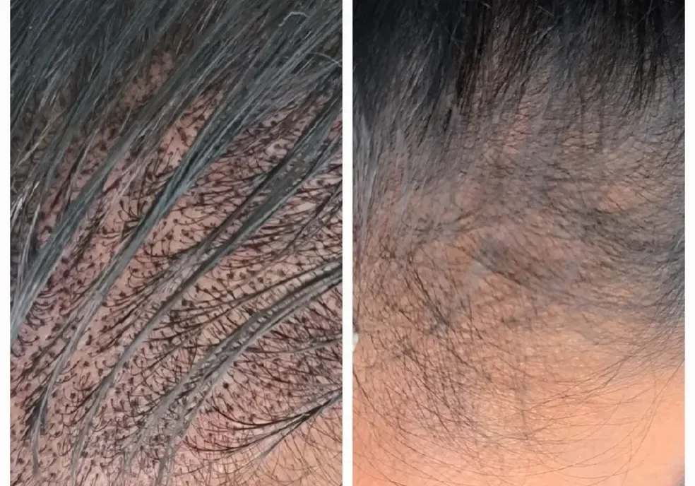 Side-by-side comparison of scalp showing significant hair regrowth over time with increased hair density and coverage.